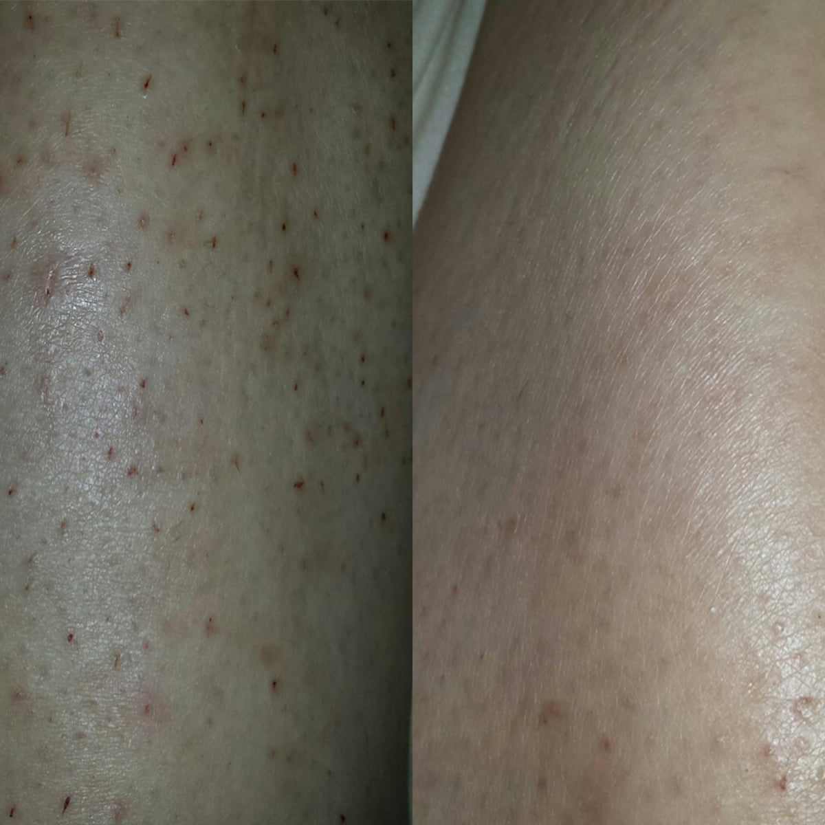 Gly + Sal Exfoliating Body Lotion