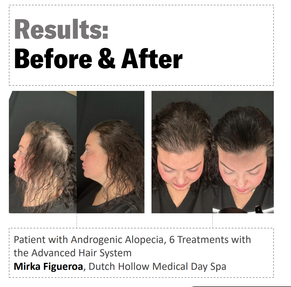 Calecim Advanced Hair System