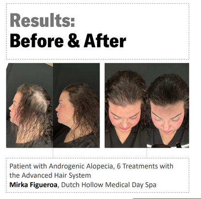 Calecim Advanced Hair System