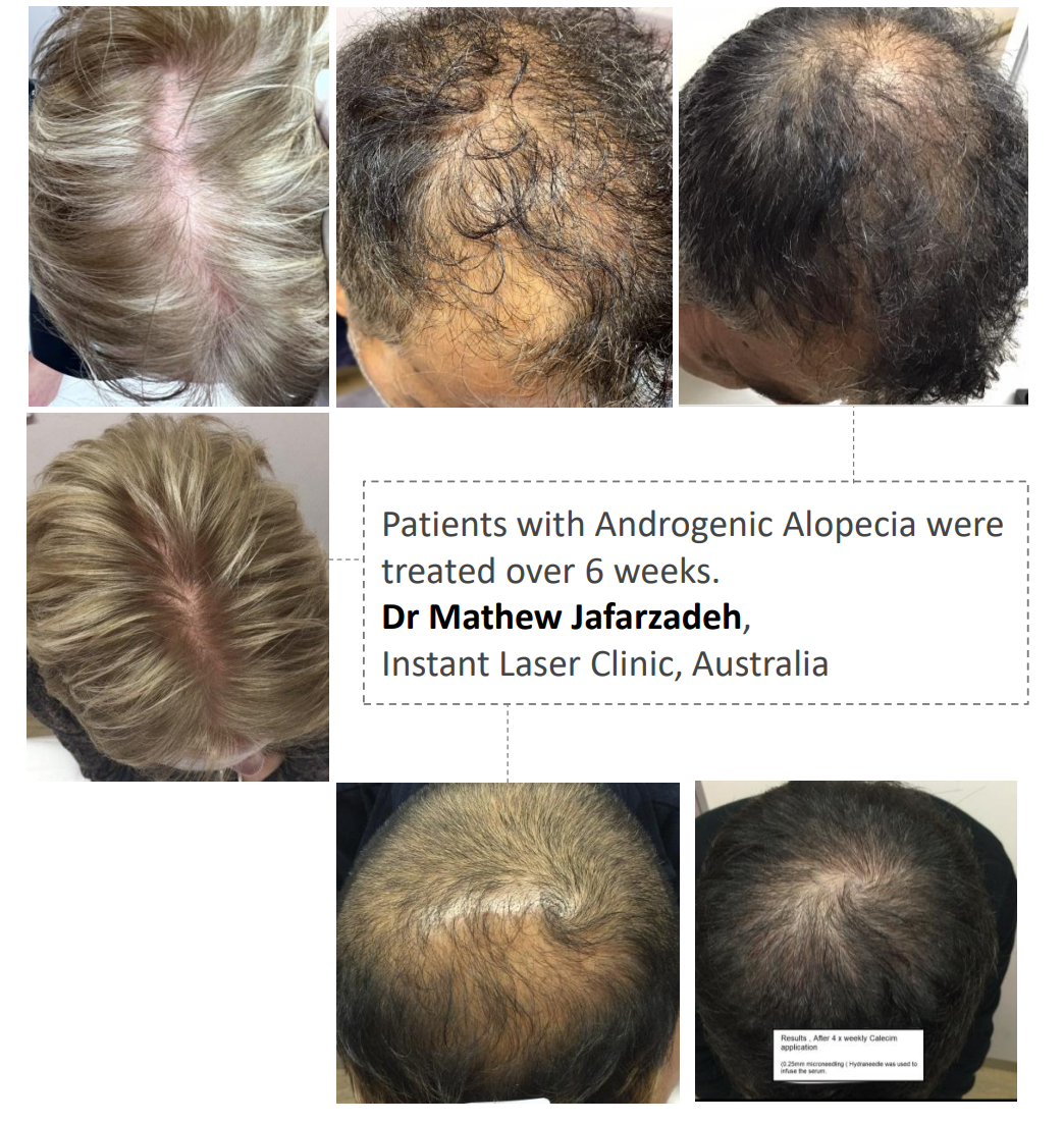 Calecim Advanced Hair System