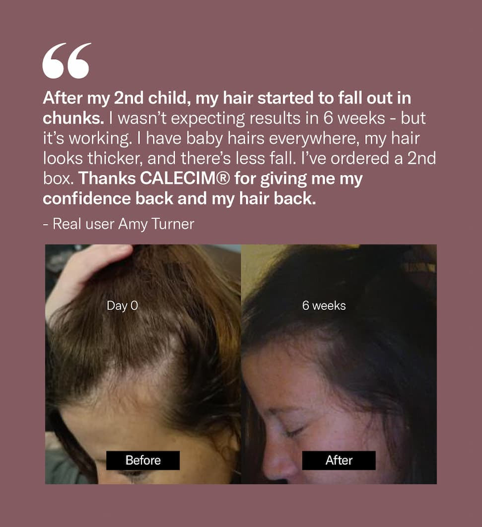 Calecim Advanced Hair System